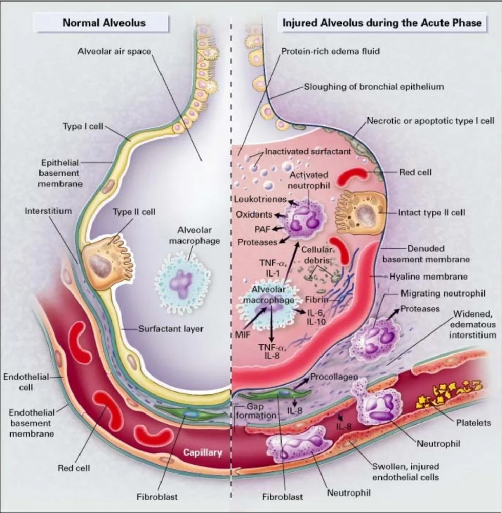 Alveoli-SARS.webp