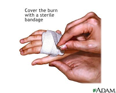 Easy-Home-Remedies-For-Minor-Burns (1).jpg