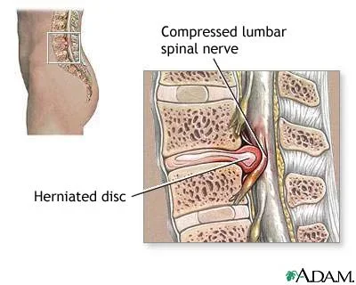 herniated-disc-adam.webp