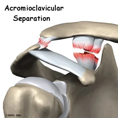 shoulder_acromioclavicular_separation_intro01.webp