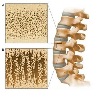 images-image_popup-w7_osteoporosis.webp