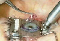 New-LASEK-laser-eye-surgery-offers-maximum-security-and-Vision.jpg