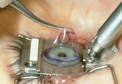 New-LASEK-laser-eye-surgery-offers-maximum-security-and-Vision.webp