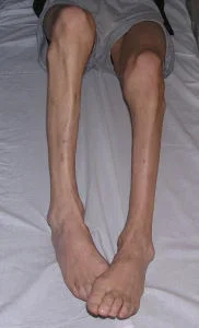 atrophy-leg.webp