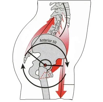 anterior-pelvic-tilt2.webp