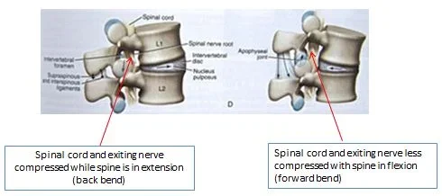 spinal_stenosis_018521.webp